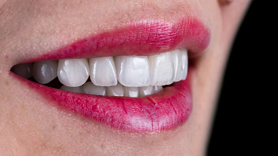 Budgeting for Brilliance: Evaluating the Cost of Porcelain Veneers for Your Smile Transformation